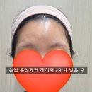 제5회 청주연묵회전 | 청주 눈썹 문신 제거 3회차 후기, 리라클의원