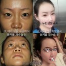 (주)두한 - 천안시 동남구 | 관자놀이, 애교살, 눈밑, 팔자주름, 턱지방이식, 뒤트임, 코재수술 두한성형외과 진솔리얼후기
