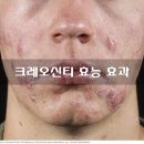 크레오신티외용액 1% 30ml 여드름 항균 크레오신티 효능 성분 부작용 주의사항 용법 이미지