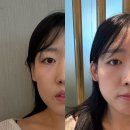바늘요정 | 귀필러 후기 및 가격 요정귀 내돈내산 후기