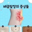 배꼽 주변 위 통증 연관 질환 증상은? 배꼽탈장 이미지