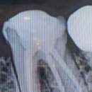 연세마이덴치과 내돈내산 신경치료 후기
