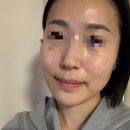 미소핀피부과의원 | 노원피부과 리투오 통증, 효과 솔직 후기 (+추천 이유)