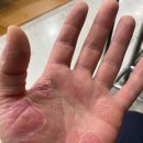 풀향기한의원 | 한포진완치 가능하게 하는 무료샘플 한포진치료법~b