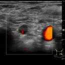 Metastatic lesion in the neck 이미지