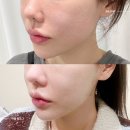 피부과모공관리 잡티제거레이저 후기 엑셀브이, 뉴아꼴레이드, 프락셀