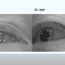 안구안진검사 설명동영상 (Video Nystagmus Graphy, VNG) 이미지