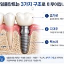 양구치과, 임플란트 브랜드보다 먼저 확인해야 할 2가지 <16년 차 의사 작성>
