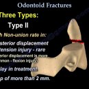 경추 2번 Odontoid 골절 이미지