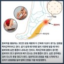 족저근막염이란 족저근막염 완치하는법 이미지