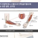 팔꿈치통증 테니스엘보(외측상과염) 골프엘보(내측상과염) 증상 이미지