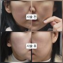 수정시흥-D-10 | 시흥배곧 기미잡티제거 잘 하는 미작뷰티에서 제로스팟 받고 온 후기