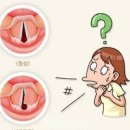 성대결절 증상 쉰목소리 목통증 원인 치료방법 이미지