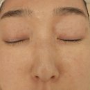 트리메디 | 울산 동구 화정동 에스떼청담 메디리프팅 체험 솔직후기