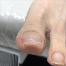 안양메디칼 | 안양 평촌역 내성발톱 전문샵 후기 미엘네일 동성제약 풀리메디 범계점