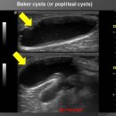 Baker cysts (or popliteal cysts) 이미지