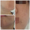 금광아파트 버스정류장 | 올가드림뷰티 금광점] 모공디톡스에서 데콜테관리 주근깨 관리 후기 전후사진