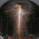 서울구로초등학교 | 구로탈모병원, 미녹시딜 효과 없어서 정수리 탈모치료 시작한 후기