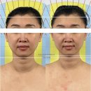 대전피부관리실, 얼굴비대칭 고수중에 찐 고수 찾는다면, 둔산동 라움리포벨