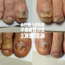 송탄베스트의원 | 클라레레이저 두꺼워진 발톱무좀치료 후기 송탄베스트의원 평택 송탄출장소 지산동 서정리역 고덕신도시...