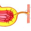 Meckel Diverticulum, 메켈 게실 이미지