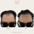 TMW 탈모왕수원 이미지