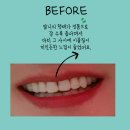 거제치과의원 | 거제향기로운치과 방문 후기/ 치아성형/ 앞니 이쁘게/ 라미네이트/