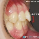 서울클리어치과교정과치과의원 | 평택역 치과 나비 모양 앞니와 과개교합이 관찰된다면? 교정을 통한 비대칭 개선 과정