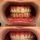 시온의빛치과교정과치과의원 | 신사역 치아미백 후기 레브치과 솔직후기