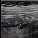 게실염(diverticulitis) 이미지