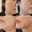 바로서면병원 | 바노바기서면 트리니티 멍 붓기 전후비교 솔직후기