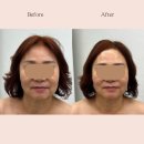 대구윤곽관리 피오라뷰티샵에서 엄마효도선물 하기