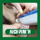 굿팜 | 사마귀 원인 발가락 손등사마귀 냉동치료 포워츠로 제거 후기