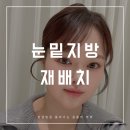 유비에이성형외과의원 | 눈밑지방제거수술가격 부담스러워 받아본 레이저눈밑지방재배치+눈밑꺼짐필러 후기