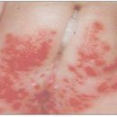 기저귀 피부염[diaper dermatitis] 이미지