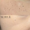 [서울/합정] 깨순이 모여라!미작뷰티 합정점에서 깨...옴. 1회로도 만족한 주근깨 제거 8개월차 찐 후기!!