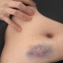 베이비멍 | 베이비아스피린 부작용 후기, 꿀팁(속쓰림, 멍)