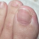 진메디팜 | 메디살 셀라팜 문제성 발톱 병풀초 솔루션 앰플 변색발톱 사용후기