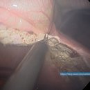 인천 담낭수술 비용｜중학생에게 발견된 2cm 담석, 단일공 복강경 담낭절제술 사례