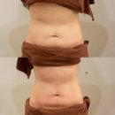에이치케이뷰티멀티샾 | 신부관리! 다산 피부관리실 미올뷰티 티리온X 올다리프팅 뱃살관리 후기