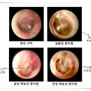 비화농성 중이염[non-suppurative otitis media] 이미지