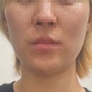 병원6층에 위치한 피부과! &lt;인어젯시술받고 양악효과봄 얼굴라인정리 팔자주름삭제 심부볼정리 리얼후기&gt;