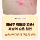 논현맑은의원 | 질여드름·외음부 주변 염증 재발의 숨은 원인: 늘어난 소음순과 구조적 변형