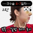 코꾸멍 | [광고X] 부산 혼자 코수술 후기 2탄 | 4~7일차 부목 제거 + 실밥 제거 + 붓기 변화 (리얼사진)