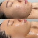 오산-청학-청학-9 | 오산 피부관리? 비용 써도 여드름 재발 했던 이유