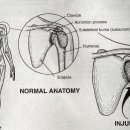 어깨 견봉하 점액낭염(Shoulder Bursitis, Subacromial) 또는 어깨 충돌증후군(Subacromial Impingement Syndrome) 이미지