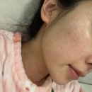 휴킨스피부과의원 | 신논현역피부과 결혼식 전 시술 리쥬란힐러 물광주사 각 2cc 솔직 후기(통증, 엠보, 효과)