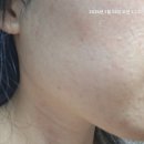 태산한의원 | 천안한의원에서 오돌토돌 모낭염피부 관리 2주 후기