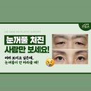 [공지] 눈꺼풀 처짐 고민인 10대부터 60대 다 모이세요! | 수원 이상호성형외과