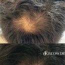 닥터브로우 | 닥터브로우 강남본점 원형탈모 smp 시술후기 탈모커버/원형탈모/숱채움